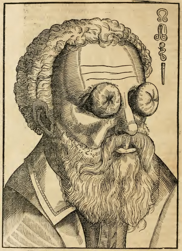 The world turned upside down: A man whose eyes have been turned inward from Bartisch.